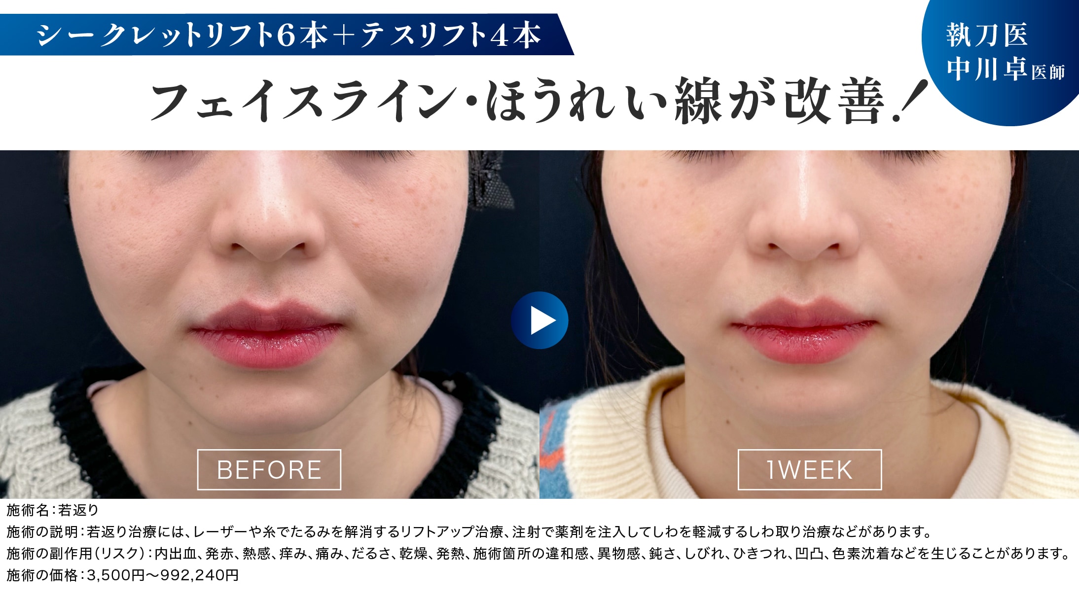 次世代の糸リフト、テスリフト⭐️